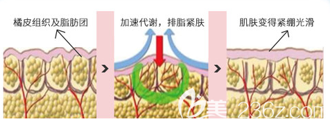 寶麗太射頻溶脂示意圖