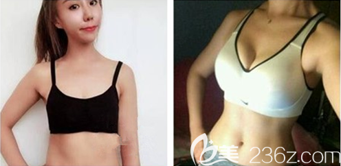 重慶聯(lián)合麗格隆胸好不好？