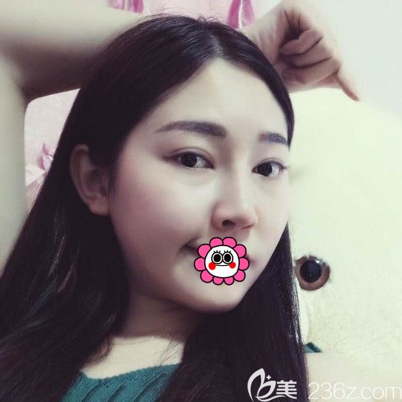 哈爾濱索菲鼻綜合術(shù)后恢復(fù)一個(gè)月效果