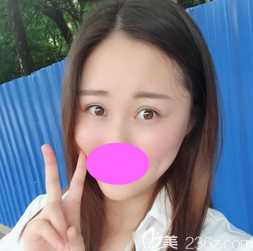 同事都說我找九江星瑞美劉志強(qiáng)割雙眼皮+開眼角一個(gè)月后的效果很自然