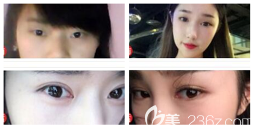 貴陽(yáng)華美雙眼皮怎么樣 貴陽(yáng)華美雙眼皮怎么樣