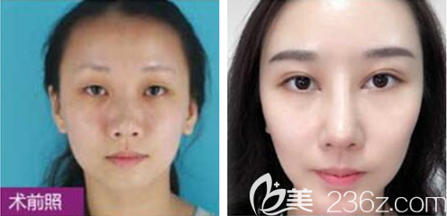 貴陽(yáng)華美韓盛斌雙眼皮案例 貴陽(yáng)華美韓盛斌雙眼皮案例