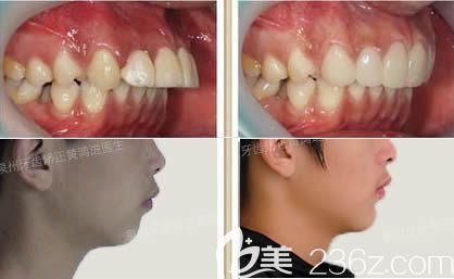 泉州維樂口腔黃鴻進(jìn)牙齒正畸效果圖