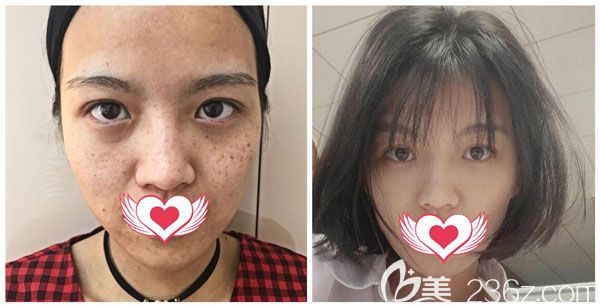 昆明夢想整形醫(yī)院超皮秒祛斑10天恢復(fù)效果對比圖