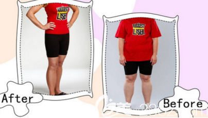 射頻溶脂案例一