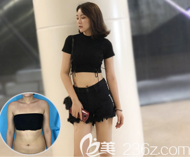 射頻溶脂腰腹脂肪案例二