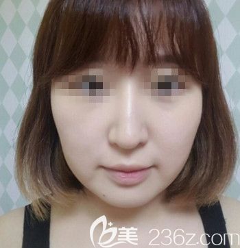 在韓國(guó)本愛(ài)做面部輪廓+鼻修復(fù)前 在韓國(guó)本愛(ài)做面部輪廓+鼻修復(fù)前