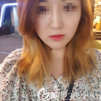 分享我找韓國本愛文圣昊院長做顴骨+下頜角+鼻修復(fù)手術(shù)3個(gè)月恢復(fù)全過程