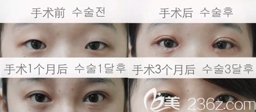 金成鎬雙眼皮真人案例 金成鎬雙眼皮真人案例