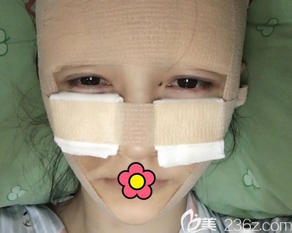 呼市京美李發(fā)成臉部脂肪填充第1天效果 呼市京美李發(fā)成臉部脂肪填充第1天效果