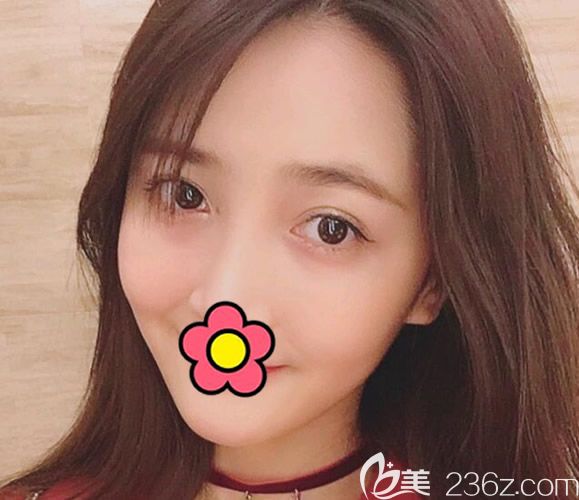 咨詢客服了解了呼和浩特京美整形價(jià)格及特邀醫(yī)師李發(fā)成坐診時(shí)間后 我做了自體脂肪面部填充