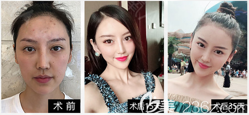廣州天姿整形醫(yī)院周褀做的悅升提升