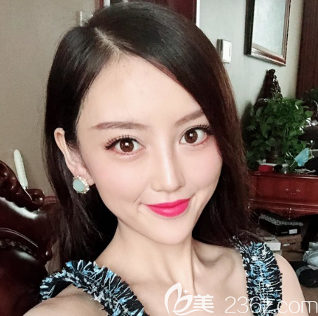 廣州做埋線提升哪家醫(yī)院好？看我花38000元找廣州天姿做的悅升線雕提升效果怎么樣？