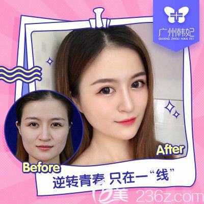 廣州韓妃陳坦醫(yī)生做的提升對(duì)比圖