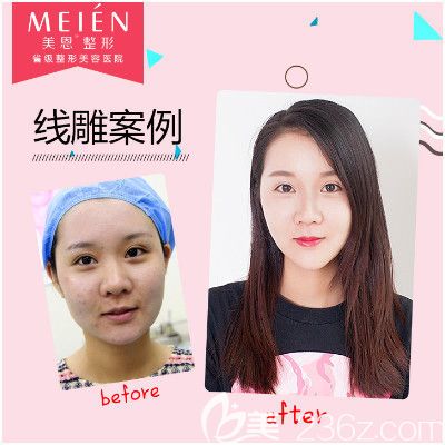 廣州美恩李豐霞醫(yī)生提升對(duì)比圖