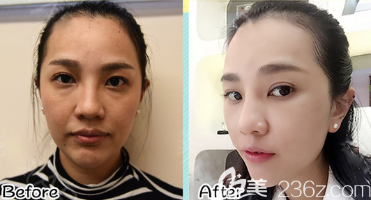 廣州美萊周杰醫(yī)生面部提升真人