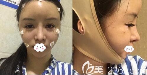 自體脂肪面部填充+面部吸脂術(shù)后即刻效果