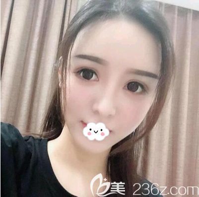 毛健清全面部脂肪填充術(shù)后3個(gè)月效果