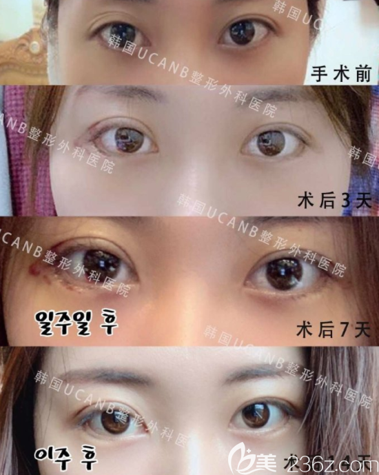 李芳碩院長眼部修復(fù)案例 李芳碩院長眼部修復(fù)案例