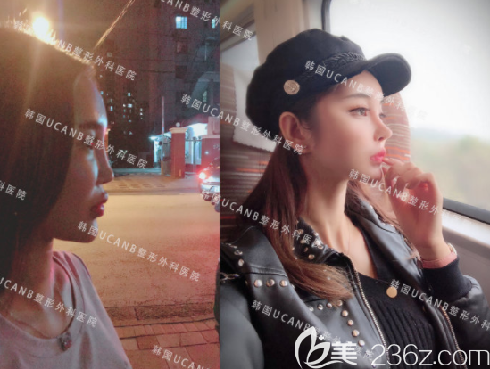 李芳碩院長鼻部修復(fù)案例 李芳碩院長鼻部修復(fù)案例