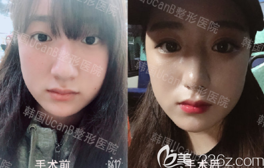 駝峰鼻矯正 駝峰鼻矯正