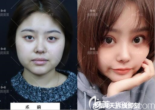 貴陽(yáng)美萊雙眼皮案例