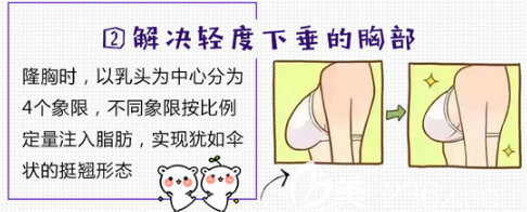 自體脂肪豐胸可以解決胸部的輕度下垂問(wèn)題 自體脂肪豐胸可以解決胸部的輕度下垂問(wèn)題