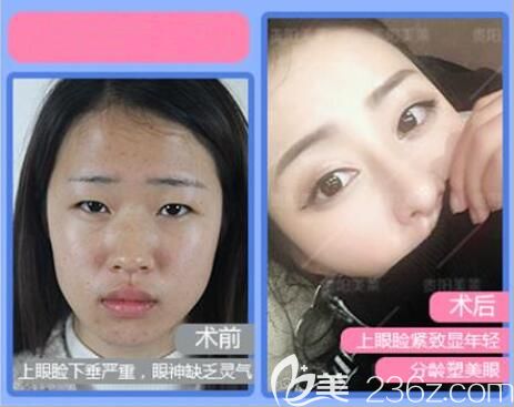 貴陽(yáng)美萊急速雙眼皮