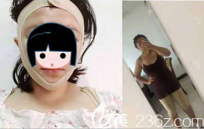 毛健清醫(yī)生陸續(xù)給我做了面部吸脂和大腿吸脂 毛健清醫(yī)生陸續(xù)給我做了面部吸脂和大腿吸脂