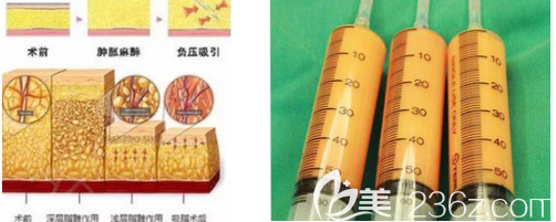 自體脂肪豐胸示意圖