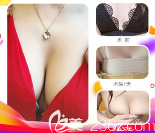 自體脂肪豐胸案例