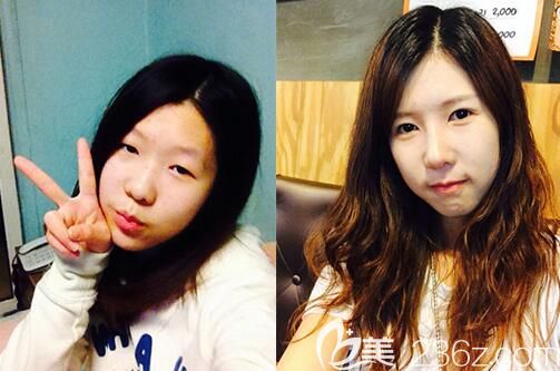 韓國YENJIN鼻綜合手術(shù)案例 韓國YENJIN鼻綜合手術(shù)案例