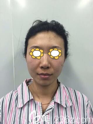 在沈陽元辰做4D綜合隆鼻+全面自體脂肪填充術(shù)前照 在沈陽元辰做4D綜合隆鼻+全面自體脂肪填充術(shù)前照