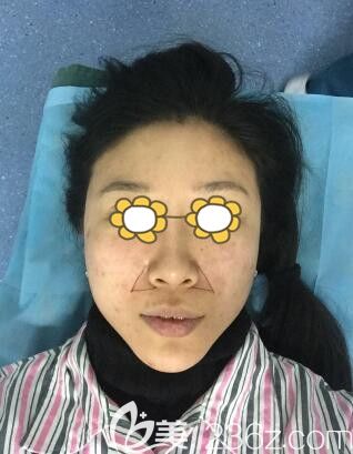 做4D綜合隆鼻+全面自體脂肪填充術(shù)前準備中 做4D綜合隆鼻+全面自體脂肪填充術(shù)前準備中