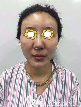 在元辰做完4D綜合隆鼻+全面自體脂肪填充后恢復(fù)期 在元辰做完4D綜合隆鼻+全面自體脂肪填充后恢復(fù)期