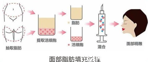 面部脂肪填充過(guò)程
