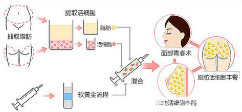 自體脂肪填充流程圖