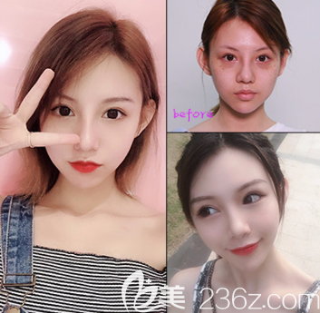 自體脂肪填充面部案例