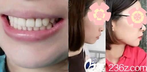 為矯正兩顆畸形怪異的虎牙,我在泉州維樂口腔佩戴了兩年的金屬牙套