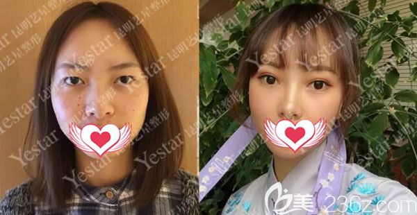 金輝做全切雙眼皮三個月案例效果