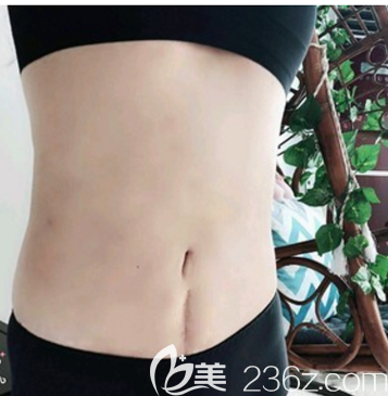 說說我去深圳富華做土麥森腰腹吸脂和自體脂肪隆胸的經(jīng)歷和感受,附吸脂手術(shù)價(jià)格表