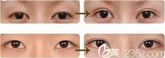 韓國成鎮(zhèn)模胎式無痕雙眼皮案例