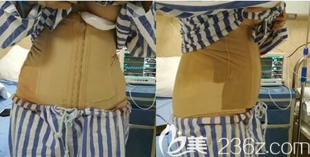 李正強(qiáng)腰腹吸脂手術(shù)術(shù)后即刻 李正強(qiáng)腰腹吸脂手術(shù)術(shù)后即刻