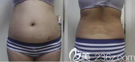抽脂手術(shù)前腰腹部脂肪多 抽脂手術(shù)前腰腹部脂肪多