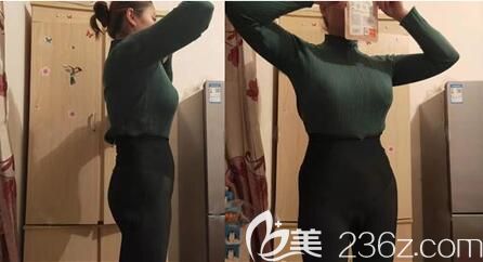 腰腹抽脂術(shù)后2個(gè)月恢復(fù)效果 腰腹抽脂術(shù)后2個(gè)月恢復(fù)效果