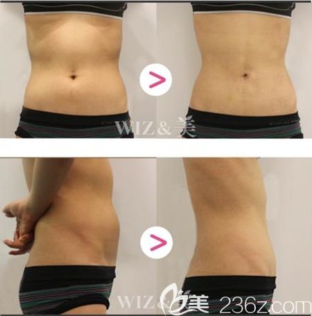 韓國WIZ美迷你吸脂針注射腰腹案例
