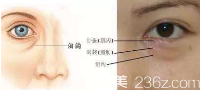 淚溝臥蠶眼袋的區(qū)分圖