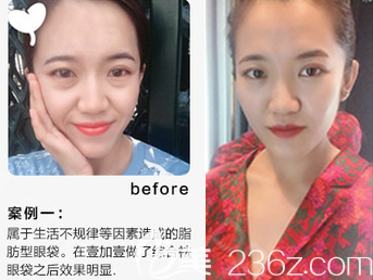 去眼袋案例圖