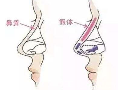 隆鼻手術(shù)(假體隆鼻(L型?I型))