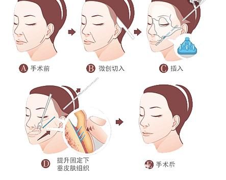 面部拉皮手術(shù)